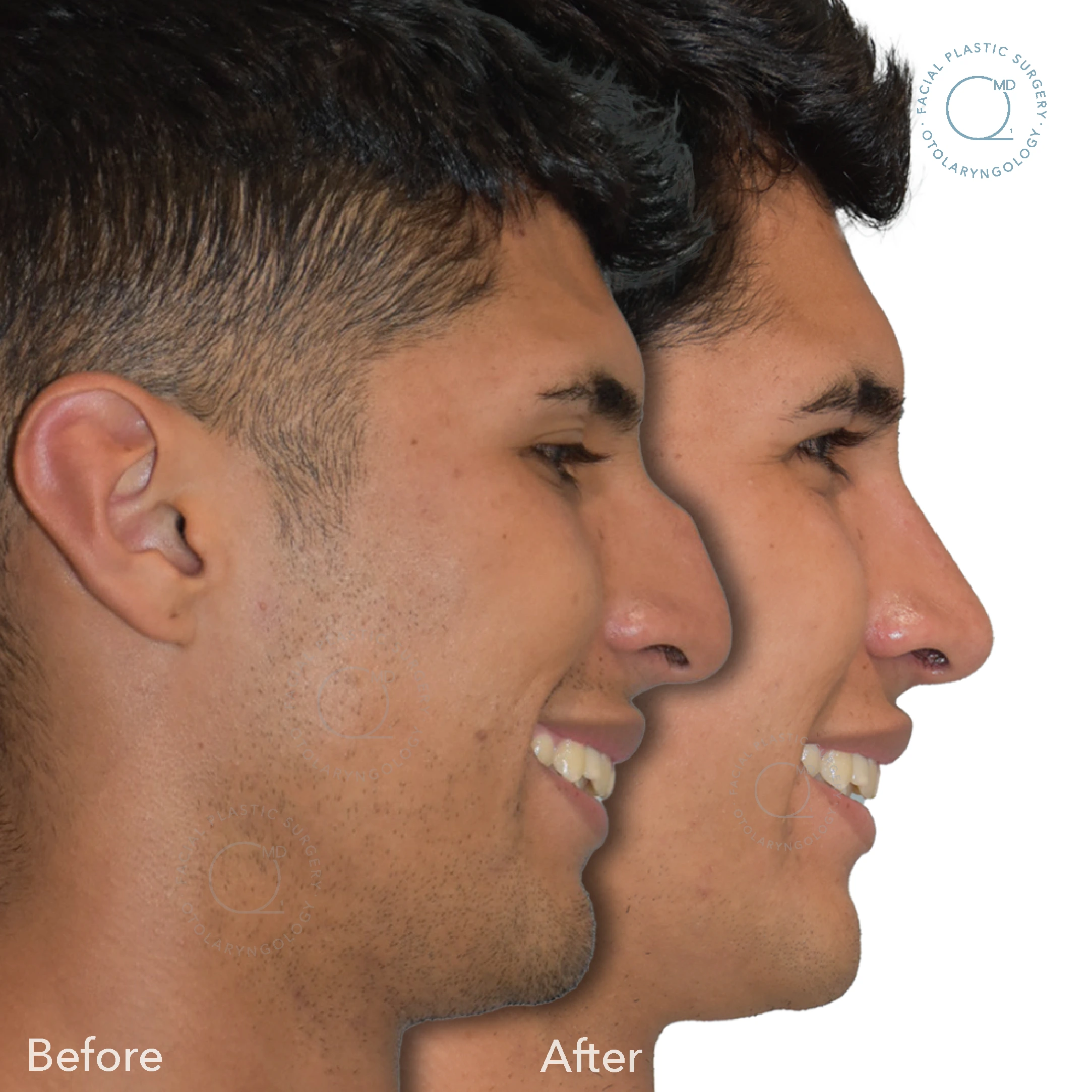 rinoplastia madrid foto galeria éxito