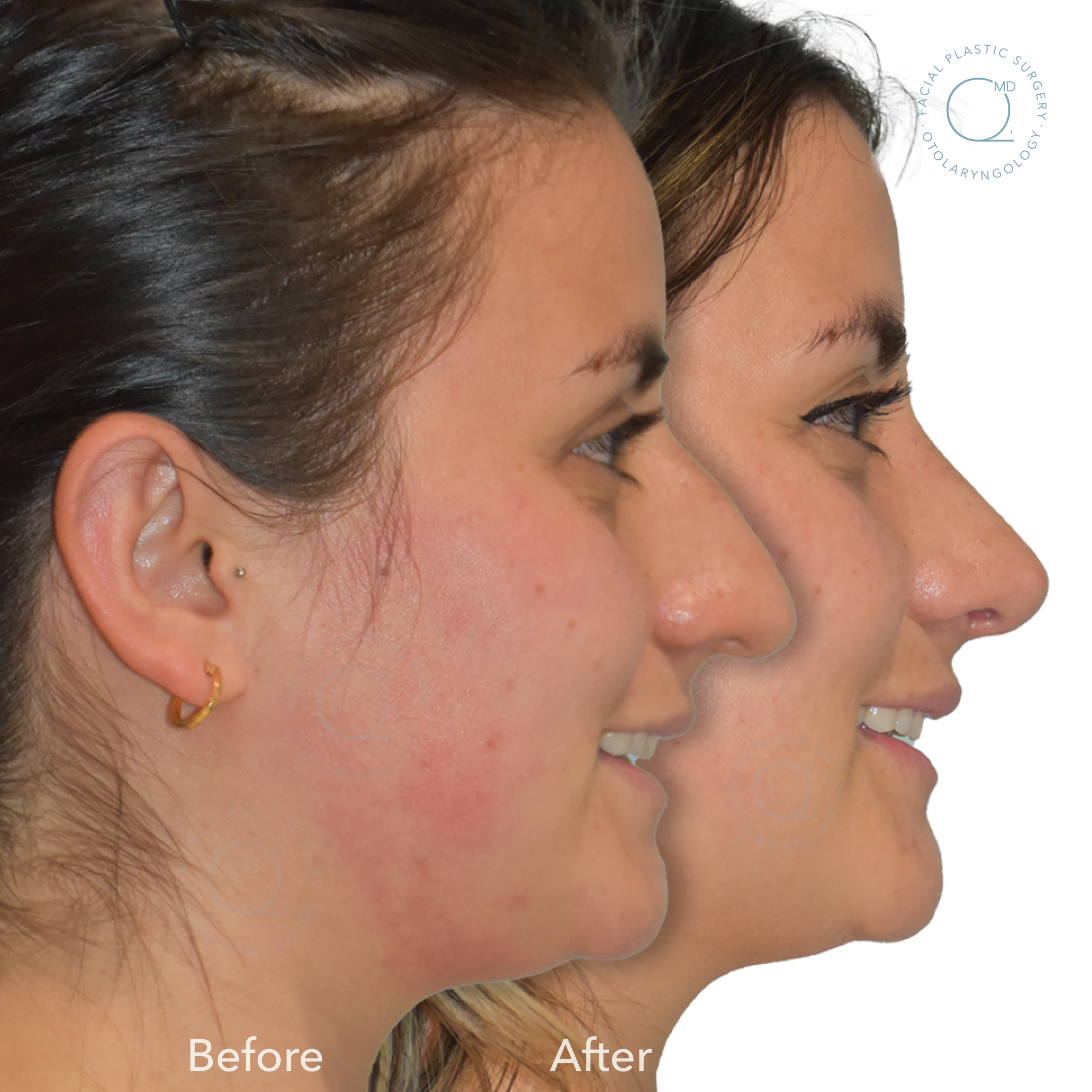 rinoplastia madrid foto nariz