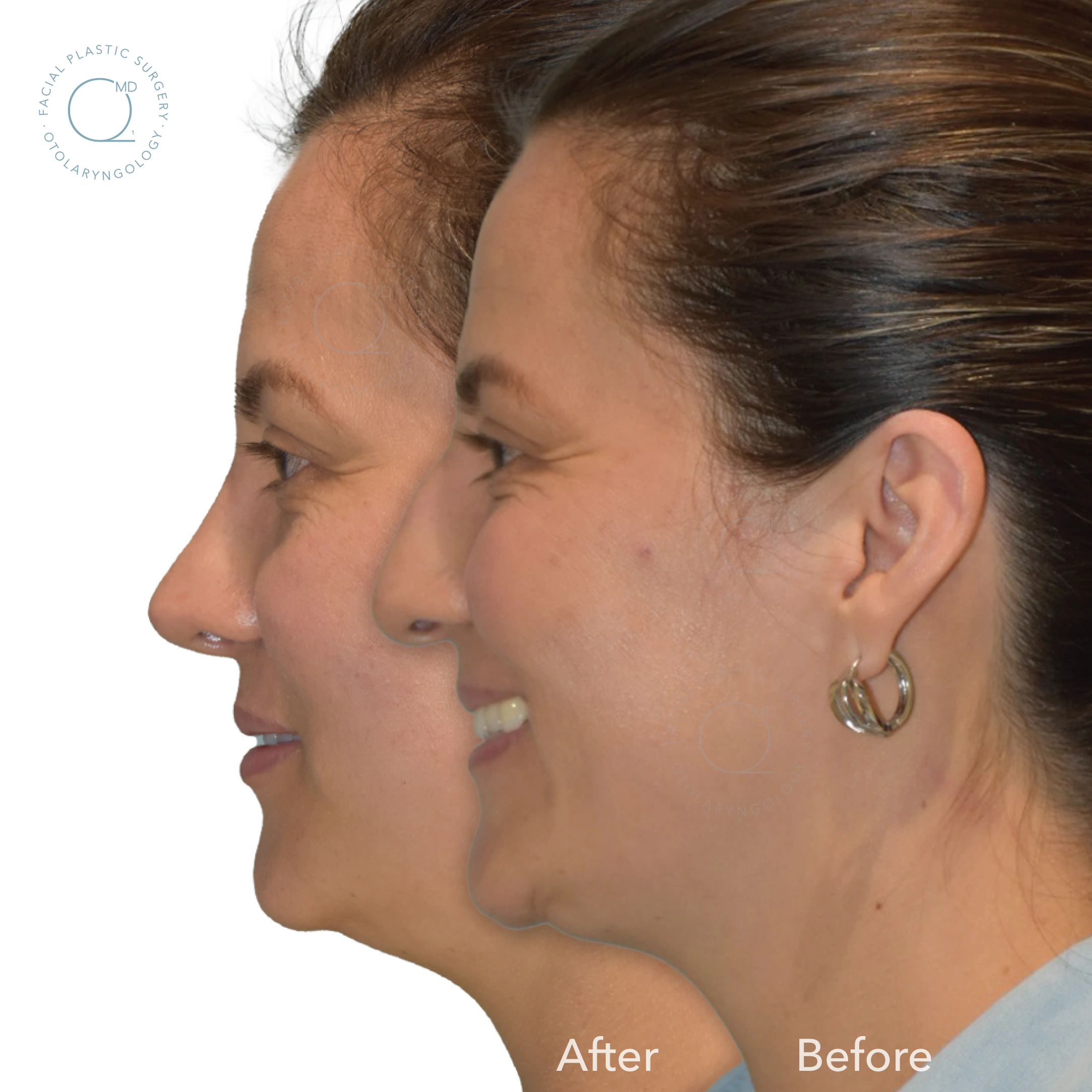 Rinoplastia Madrid galeria nariz