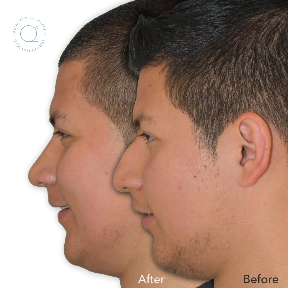 foto-rinoplastia-madrid-caso-32
