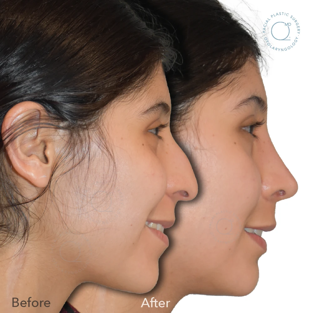 foto-rinoplastia-madrid-caso-39