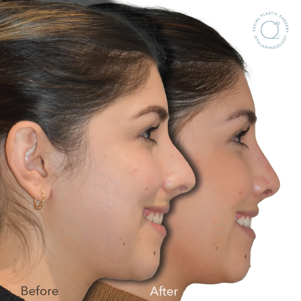 foto-rinoplastia-madrid-caso-40