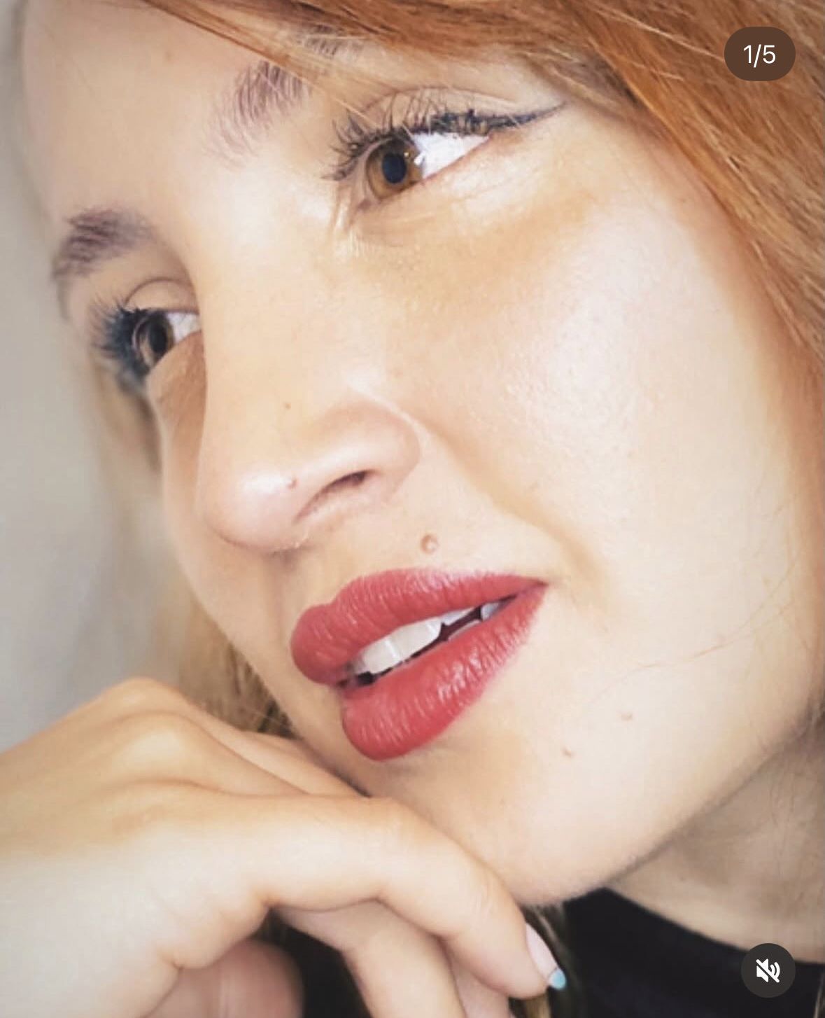 Rinoplastia Madrid paciente Clínicas Duque
