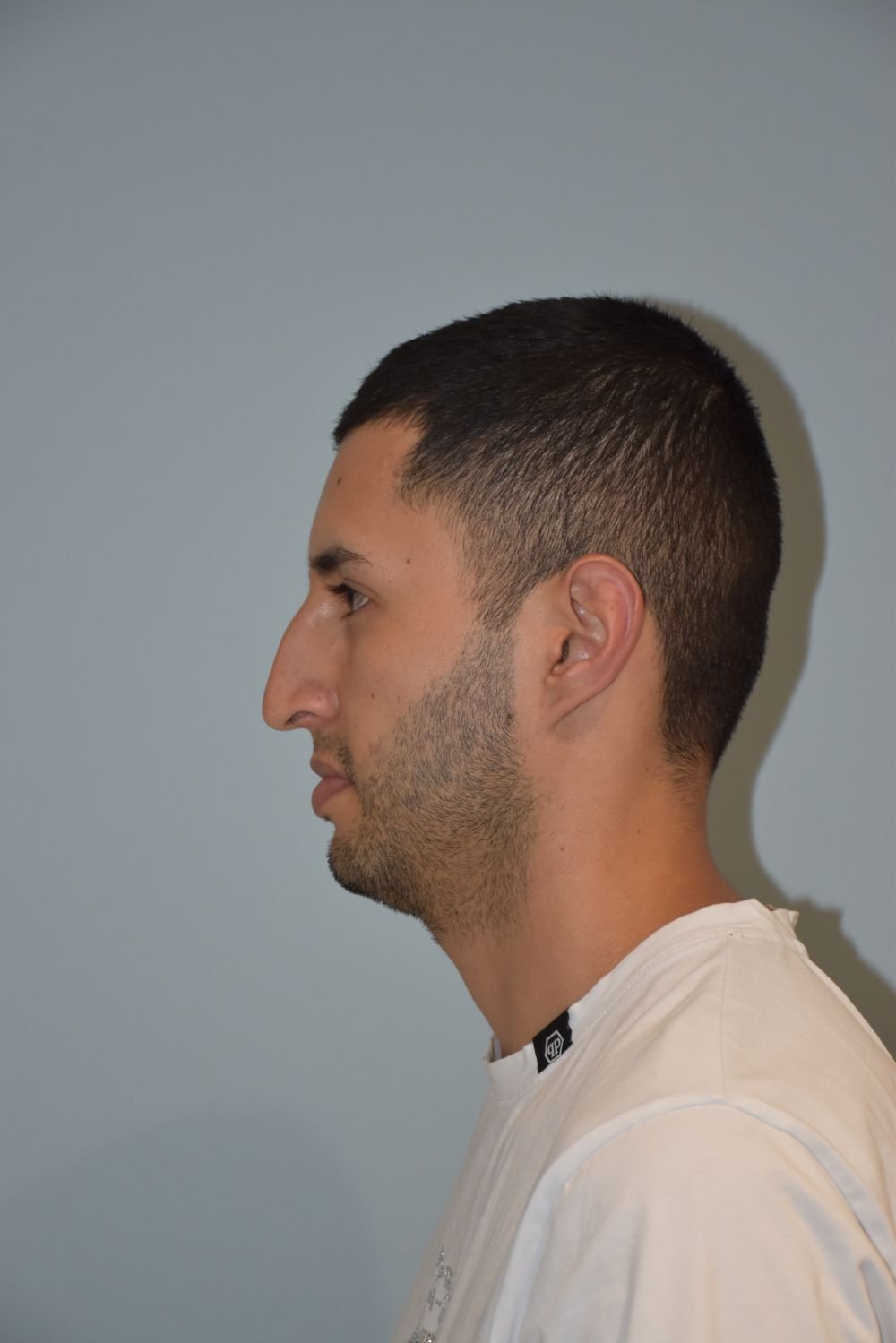 Rinoplastia Madrid caso 3 fotografía 1