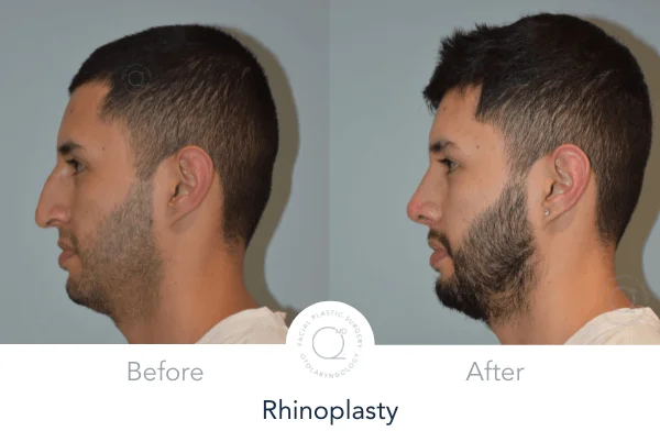 Rinoplastia Madrid caso 3 fotografía 4