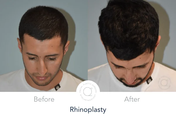 Rinoplastia Madrid caso 3 fotografía 7