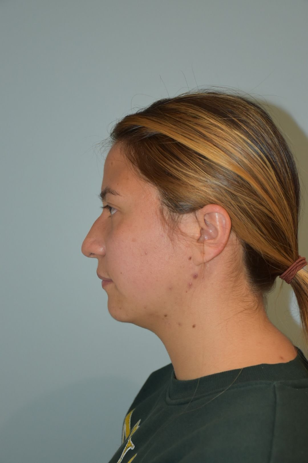 Rinoplastia Madrid caso 9 fotografía 1