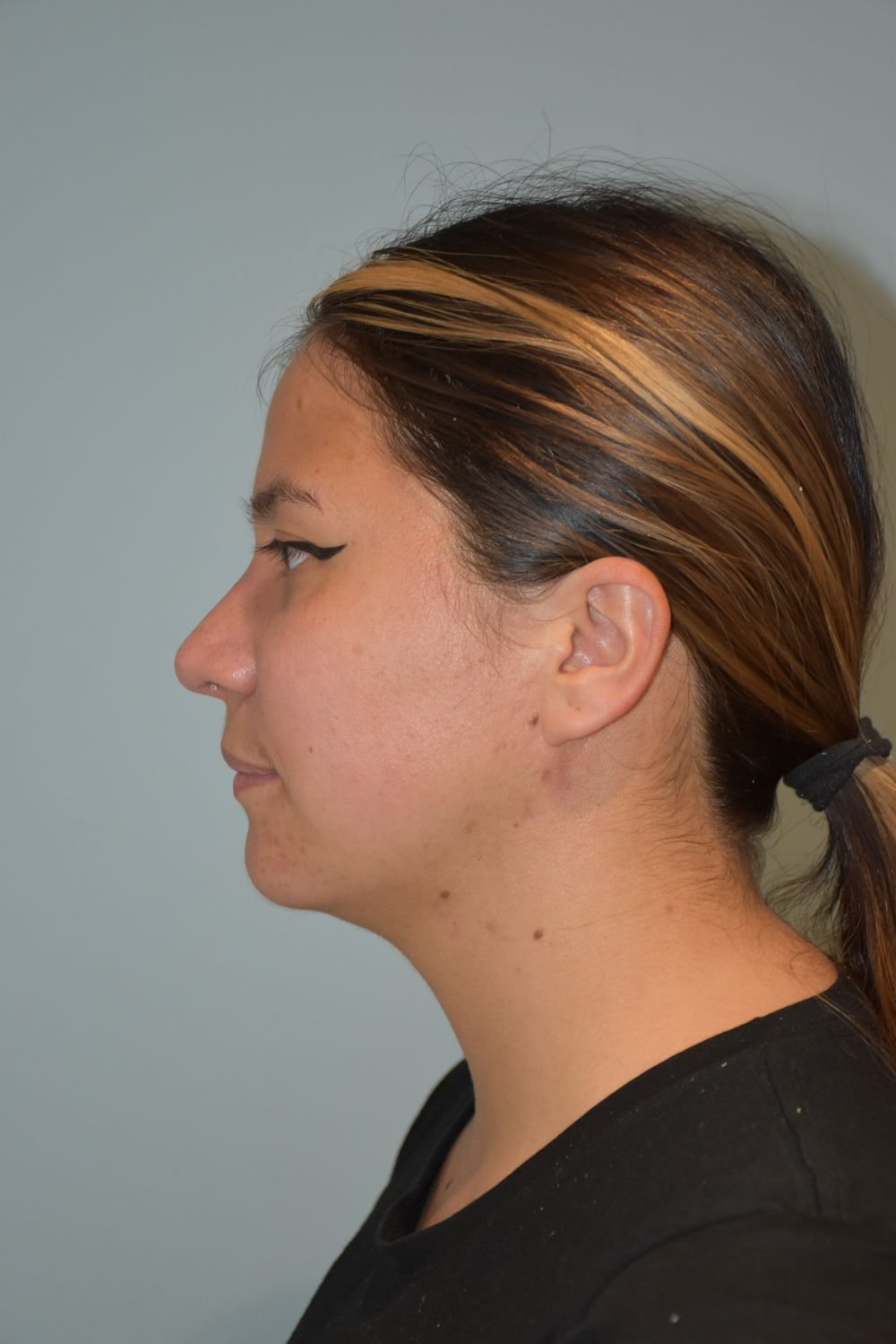 Rinoplastia Madrid caso 9 fotografía 2