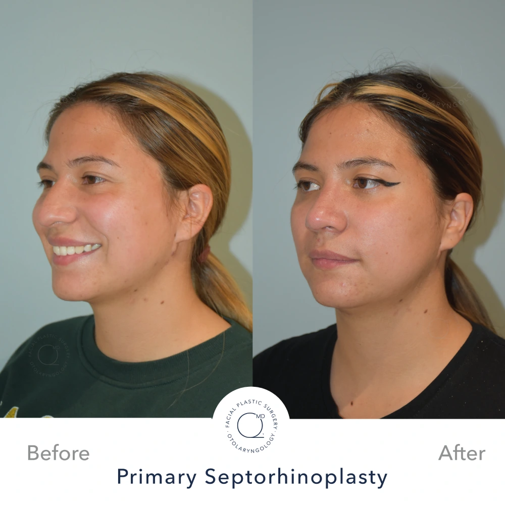 Rinoplastia Madrid caso 9 fotografía 5