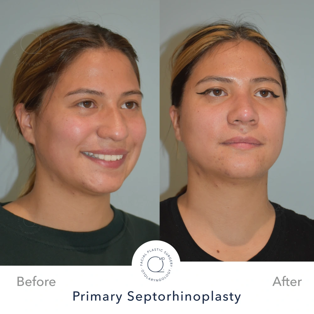 Rinoplastia Madrid caso 9 fotografía 6