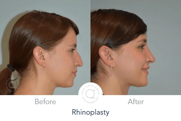 Rinoplastia Madrid caso 13 fotografía 3