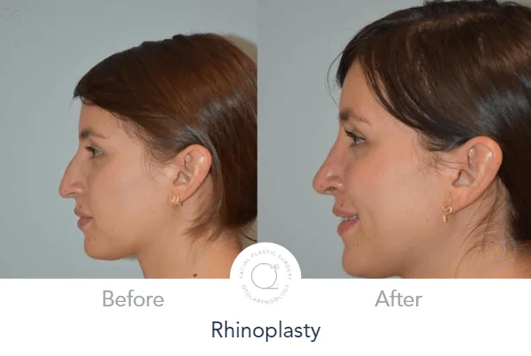Rinoplastia Madrid caso 13 fotografía 4