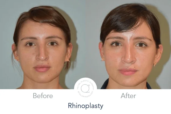 Rinoplastia Madrid caso 13 fotografía 5