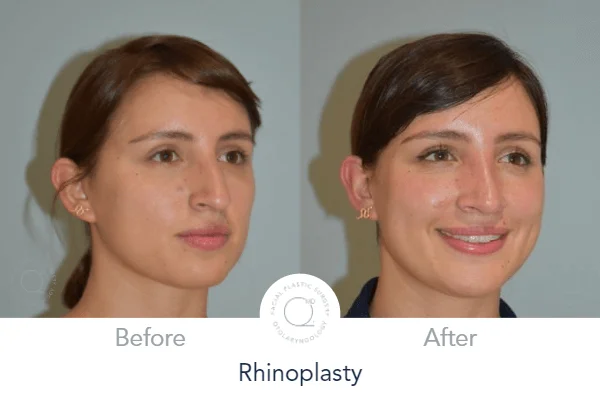 Rinoplastia Madrid caso 13 fotografía 6