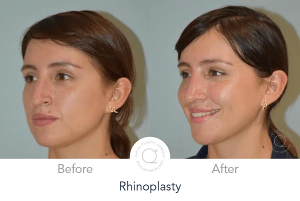 Rinoplastia Madrid caso 13 fotografía 7