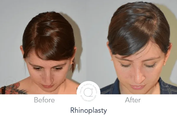 Rinoplastia Madrid caso 13 fotografía 8