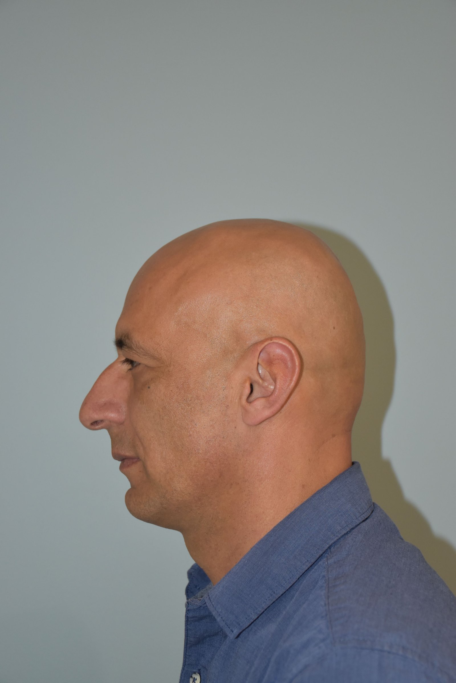 Rinoplastia Madrid caso 20 fotografía 1