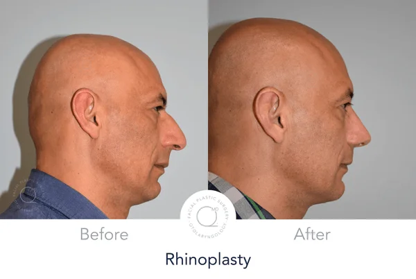 Rinoplastia Madrid caso 20 fotografía 3