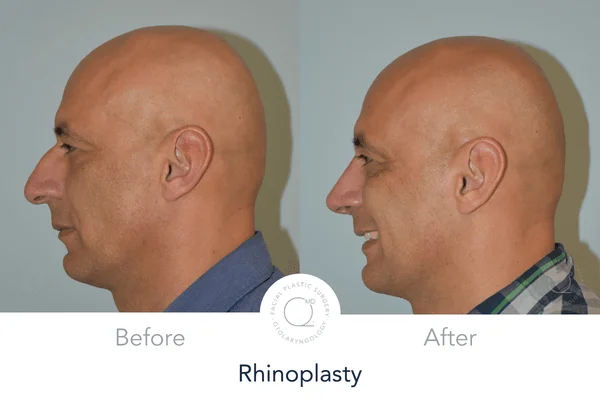 Rinoplastia Madrid caso 20 fotografía 4