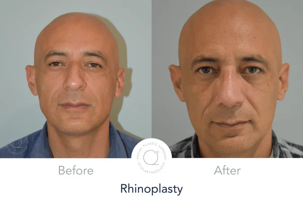 Rinoplastia Madrid caso 20 fotografía 5