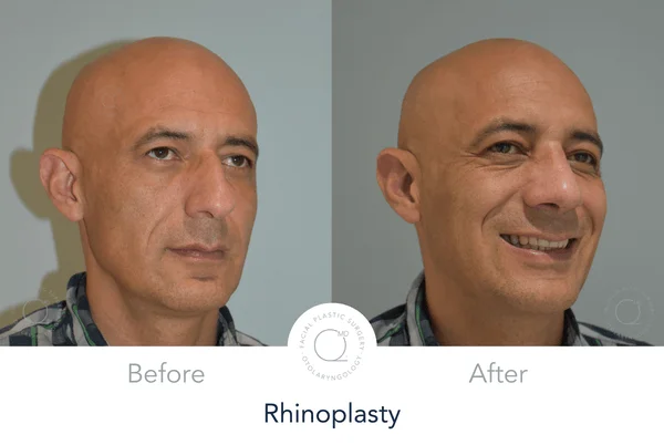 Rinoplastia Madrid caso 20 fotografía 6