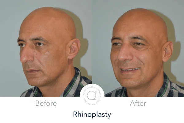 Rinoplastia Madrid caso 20 fotografía 7
