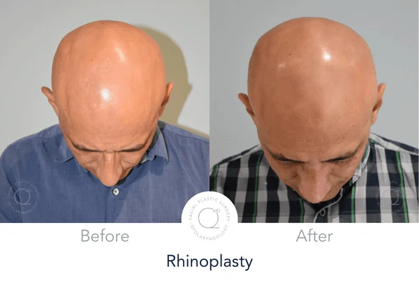 Rinoplastia Madrid caso 20 fotografía 8