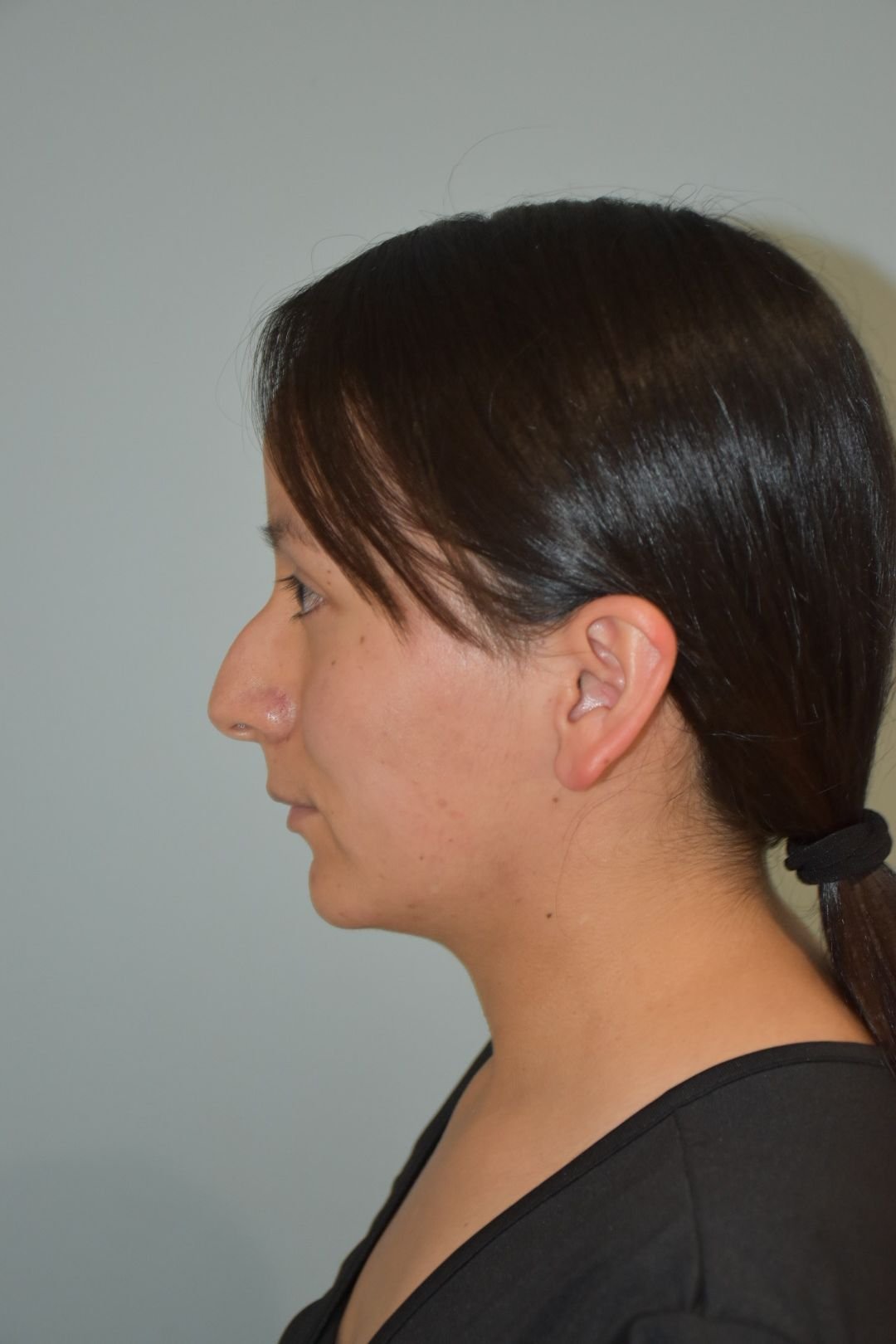 Rinoplastia Madrid caso 21 fotografía 1
