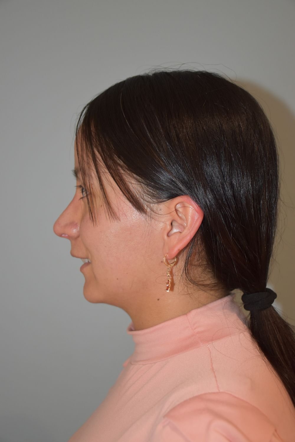 Rinoplastia Madrid caso 21 fotografía 2