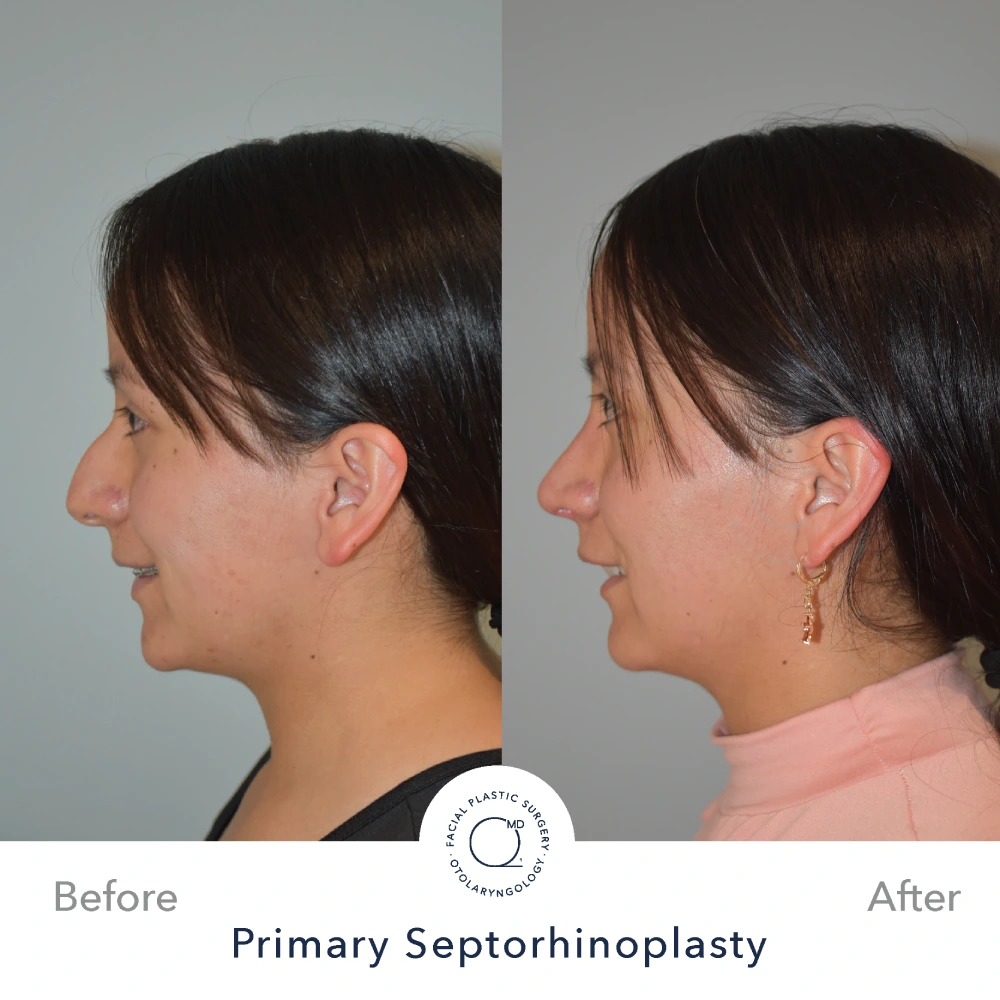 Rinoplastia Madrid caso 21 fotografía 3