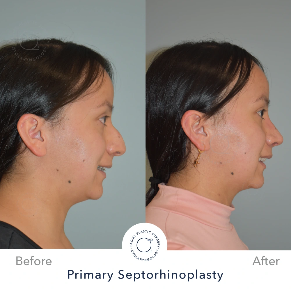 Rinoplastia Madrid caso 21 fotografía 4