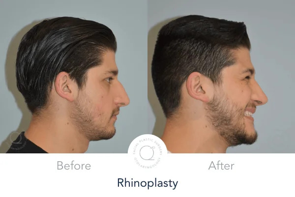 Rinoplastia secundaria reconstructiva antes y después - Caso 5 Dr. Jorge Duque Silva Madrid