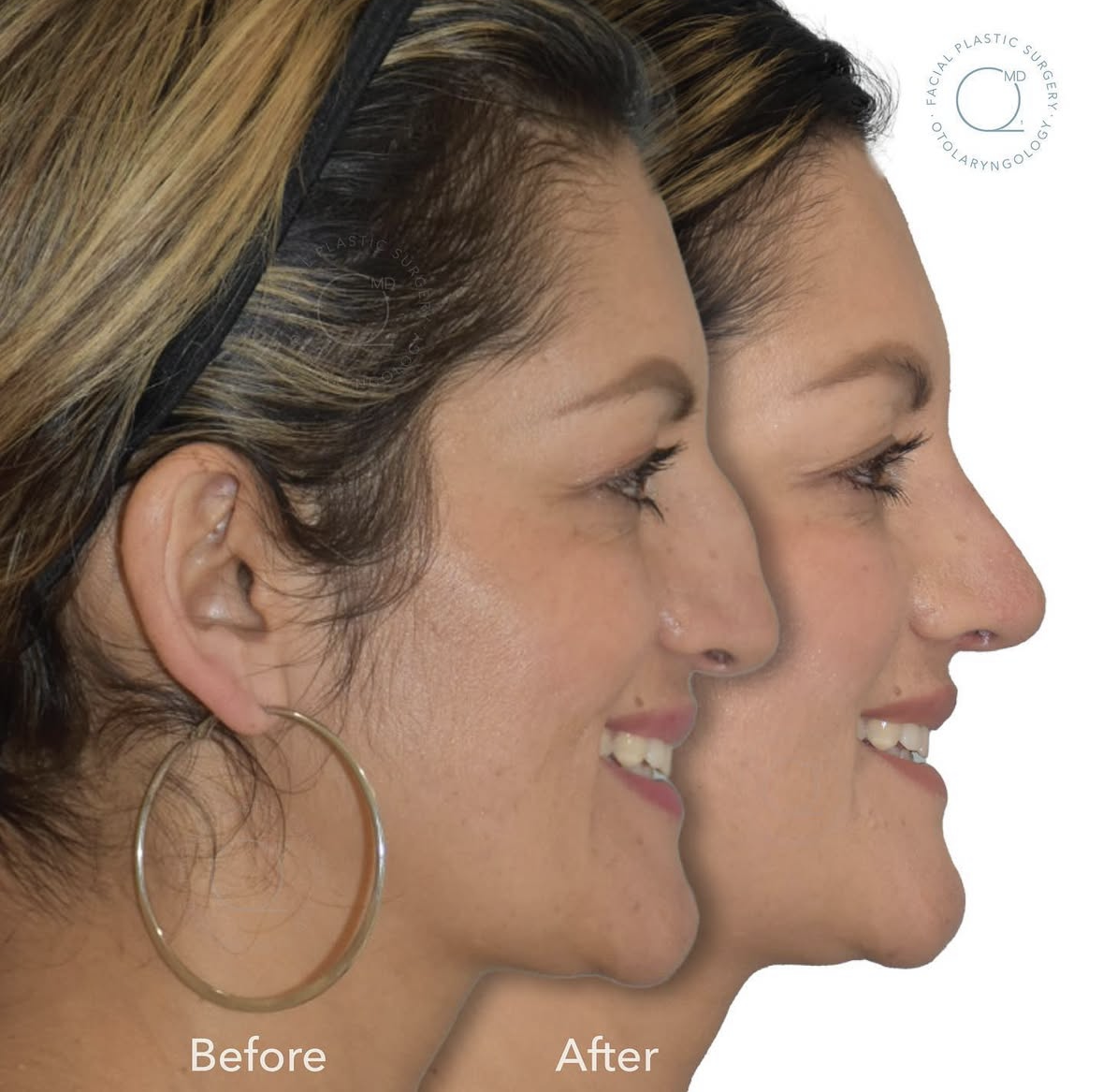 Resultado documentado antes y después de una rinoplastia; abrir todas las fotografías del caso 1