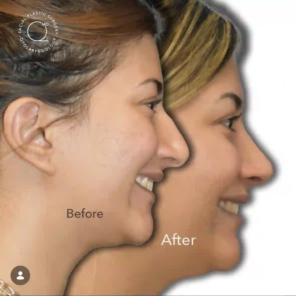 Caso clínico de rinoplastia de revisión con vistas antes y después
