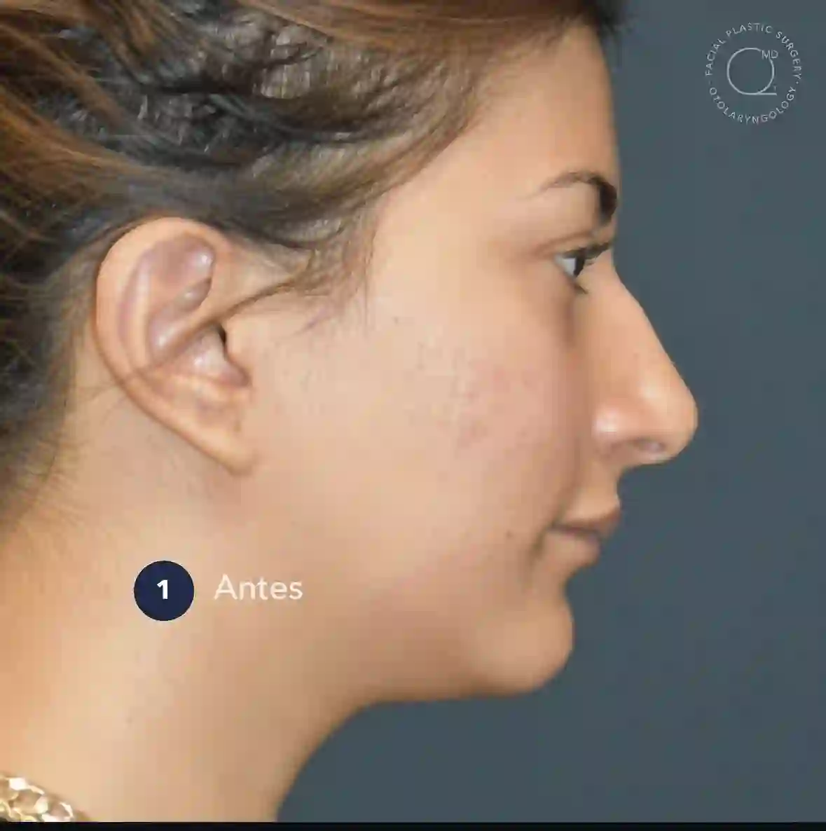 Caso de rinoplastia de revisión, etapa 1: antes