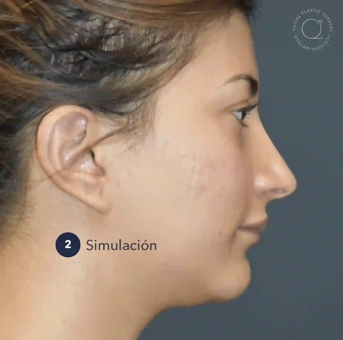 Caso de rinoplastia de revisión, etapa 2: simulación