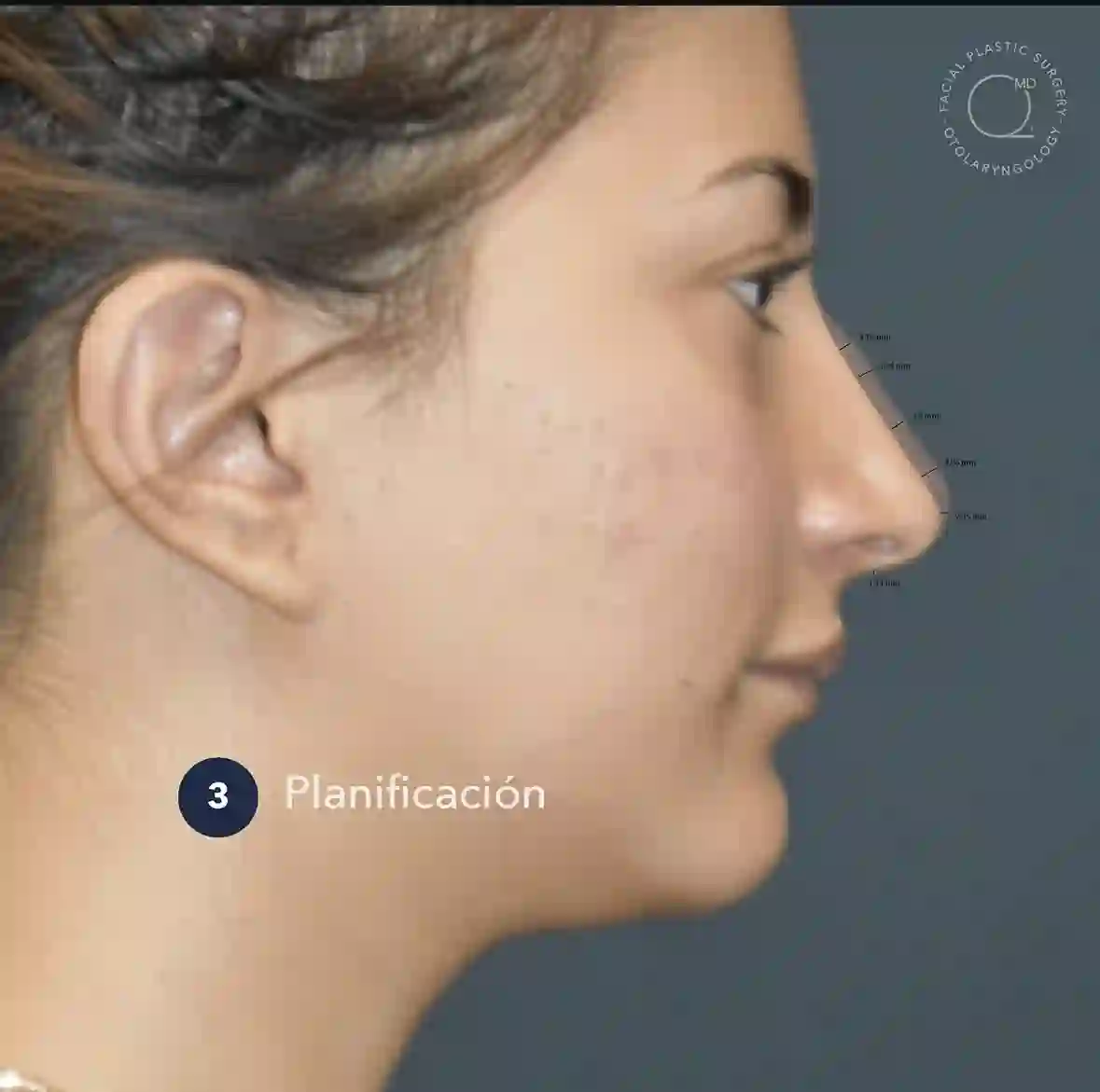 Caso de rinoplastia de revisión, etapa 3: planificación con mediciones