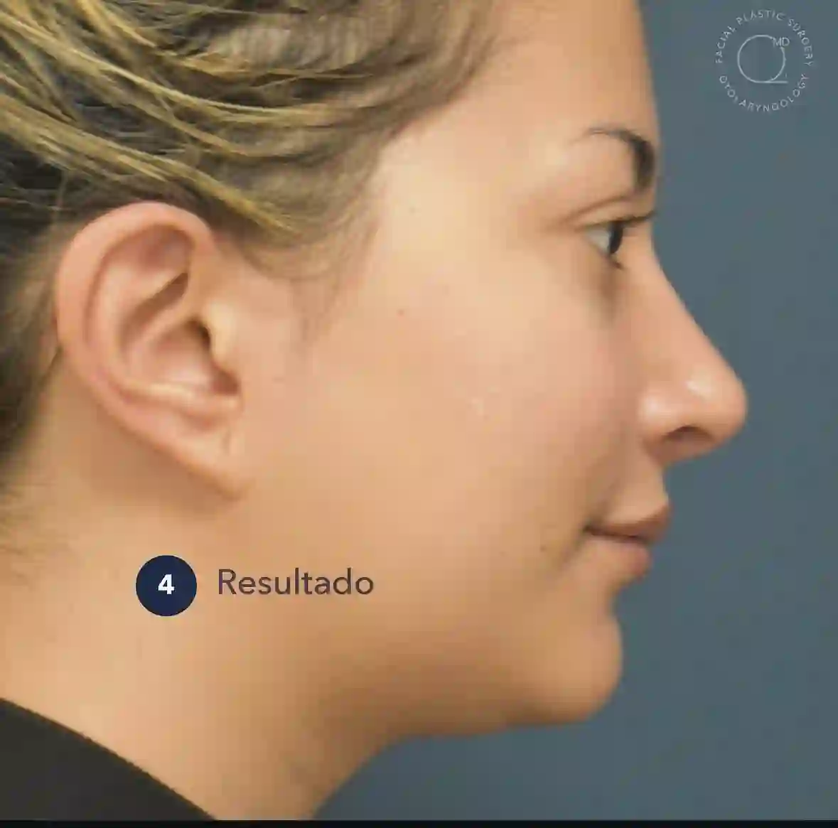 Caso de rinoplastia de revisión, etapa 4: resultado