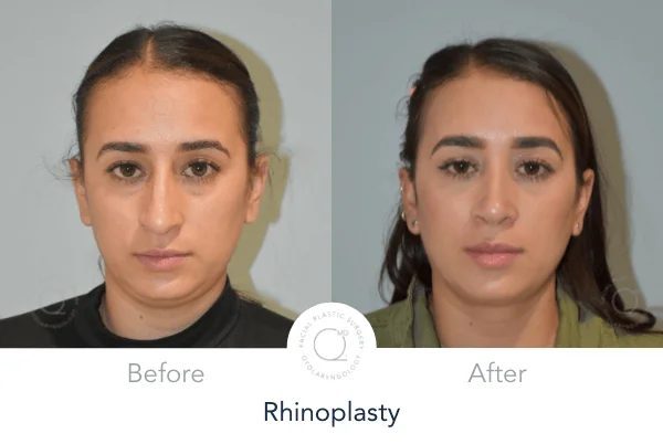 Rinoplastia Madrid foto mujer antes