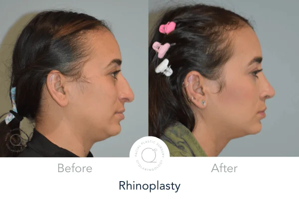 Rinoplastia madrid foto mujer