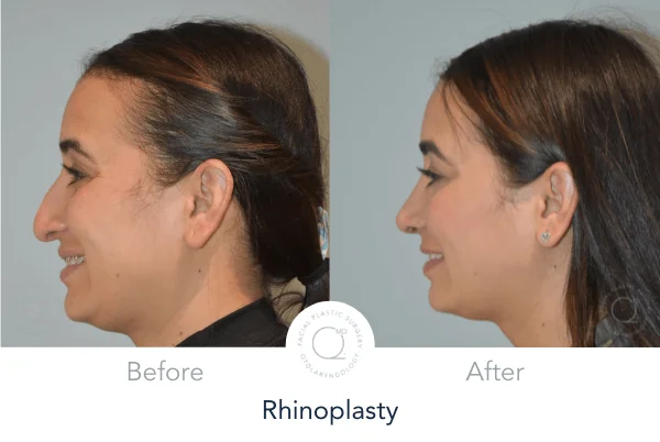 Rinoplastia madrid foto mujer despues