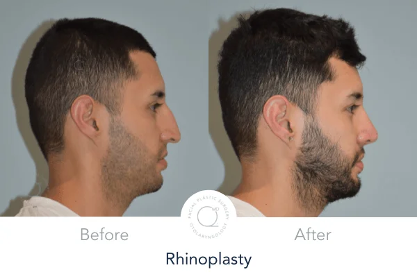 Rinoplastia madrid hombre foto antes