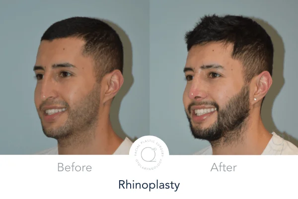 Rinoplastia Madrid foto hombres izquierda antes