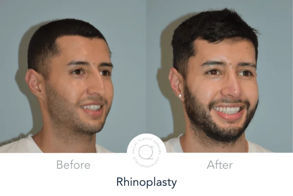 Rinoplastia Madrid foto hombre derecha despues