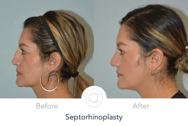 Rinoplastia Madrid Septorrinoplastia