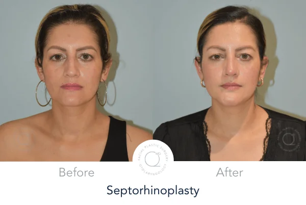 Rinoplastia Madrid mejor rinoplastia Nariz