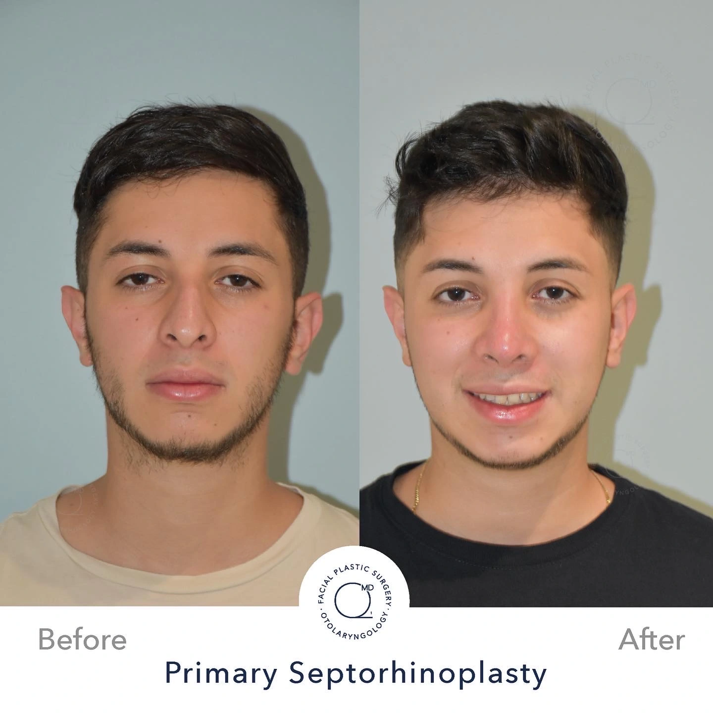 foto hombre rinoplastia clinicas duque Madrid