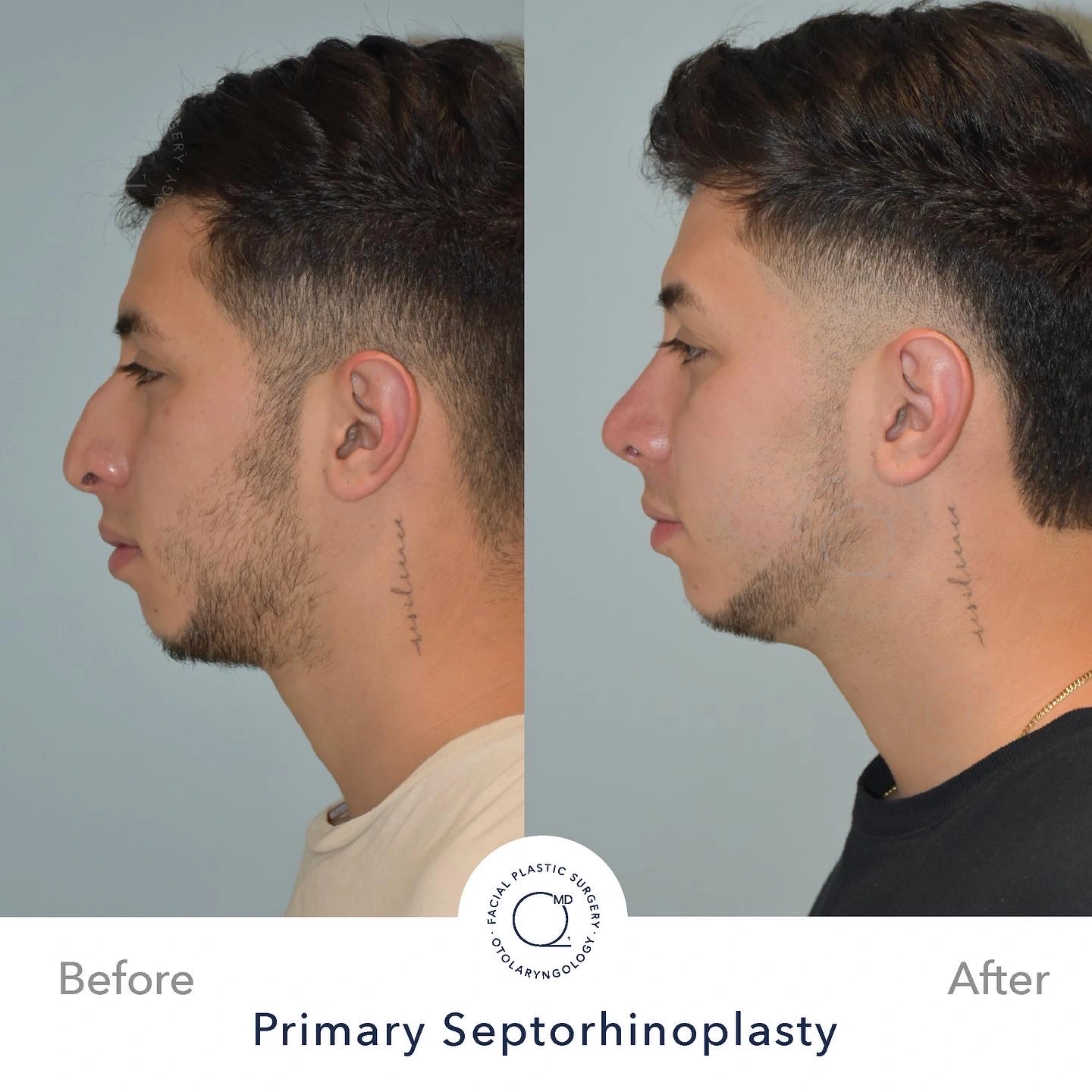 foto hombre rinoplastia Madrid