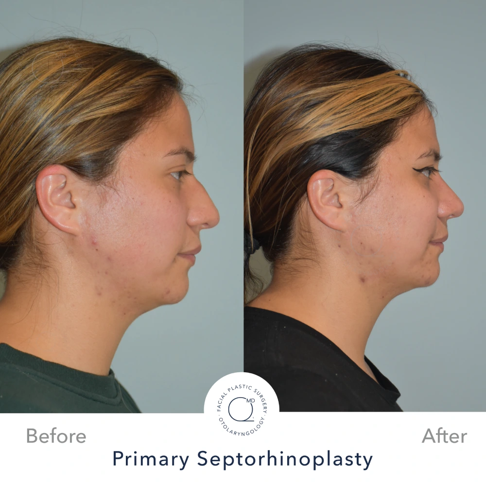 foto perfil rinoplastia madrid doctor Duque