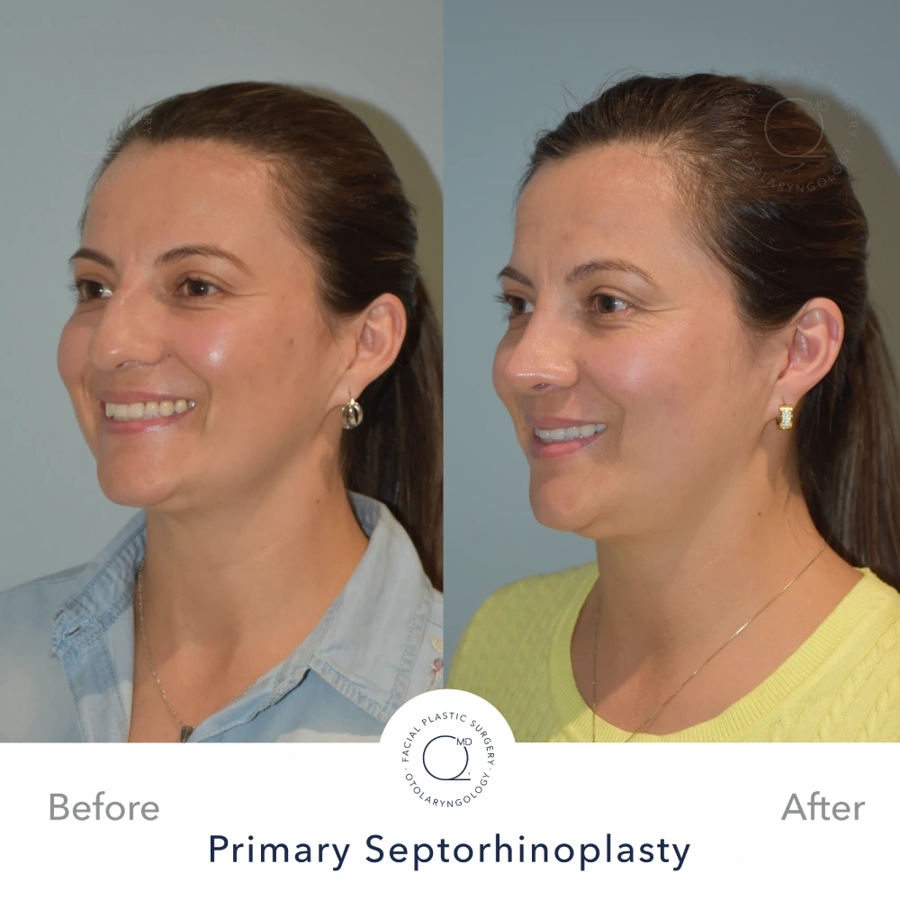 foto rinoplastia despues mujer